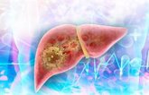 Foto: Solo uno de cada cuatro pacientes con VIH y hepatitis B recibe el cribado recomendado para cáncer de hígado