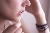 Foto: El truco para prevenir el herpes labial este verano: usar bálsamo con protección solar