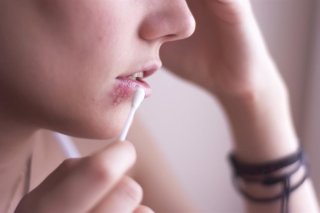 Archivo - Herpes en el labio.