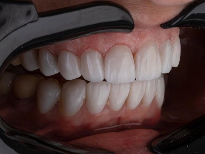 Rehabilitación oral completa: cómo recuperar una dentadura fija con carga inmediata incluso en casos complejos