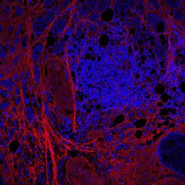Fibroblastes de cáncer de mama
