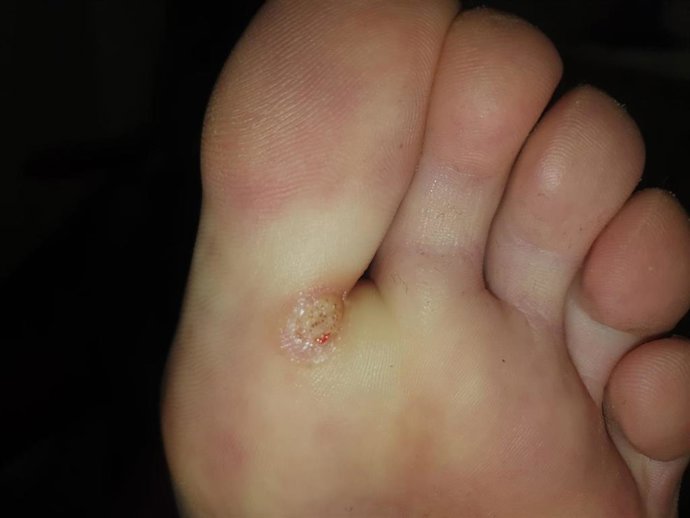 Pie con papiloma.