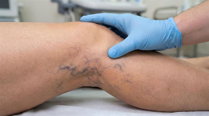 Imagen de recurso de unas varices.