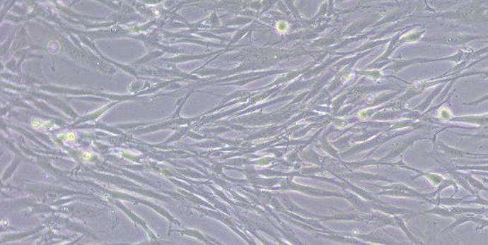 Fibroblastos actúan como escudo en cáncer de vías biliares intrahepático para resistir a quimioterapia, según un estudio