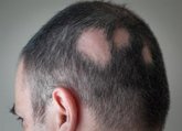 Foto: Los farmacéuticos destacan su papel en la detección precoz de la alopecia areata