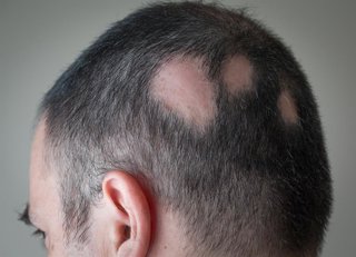 Archivo - Los farmacéuticos destacan su papel en la detección precoz de la alopecia areata