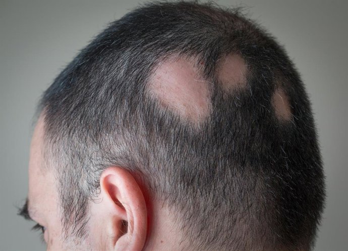 Archivo - Los farmacéuticos destacan su papel en la detección precoz de la alopecia areata