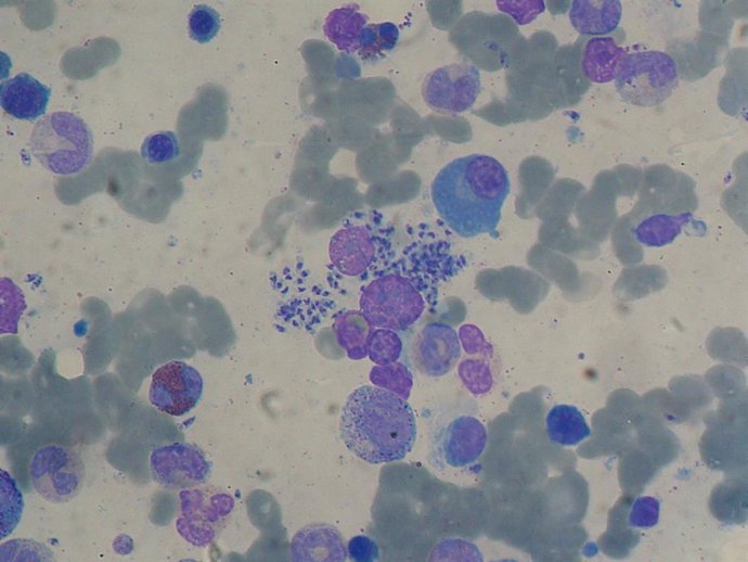 Archivo - Células de médula ósea afectadas por leishmaniasis visceral. /