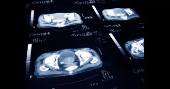 Un estudio asocia el uso prolongado de tadalafilo para la próstata con un mayor riesgo de glaucoma
