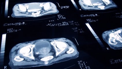 Un estudio asocia el uso prolongado de tadalafilo para la próstata con un mayor riesgo de glaucoma