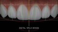 COMUNICADO: Instituto Smile Design by Fernando Soria apuesta por las carillas de porcelana en una sola sesión