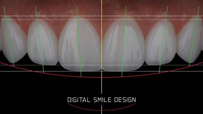 Instituto Smile Design by Fernando Soria apuesta por las carillas de porcelana en una sola sesión