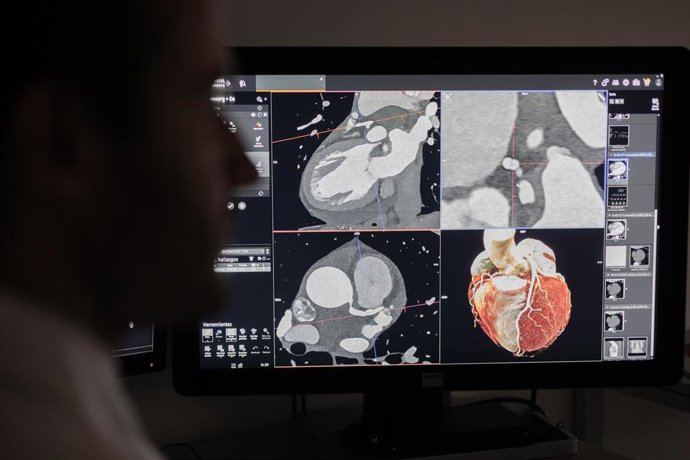 Archivo - Las imágenes obtenidas con el escáner Photon Counting ofrecen mayor precisión de las arterias coronarias y de los posibles estrechamientos.