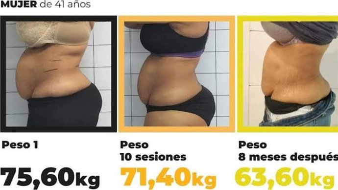 La FDA autoriza Drakarian de Capenergy Medical para la reducción de grasa abdominal en Estados Unidos