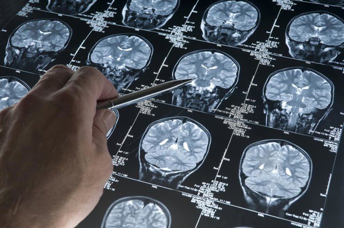 Archivo - Imagen de recuros del estudio de un cerebro.
