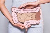 Foto: Un estudio cuestiona el supuesto beneficio del sobrepeso en la supervivencia del cáncer colorrectal