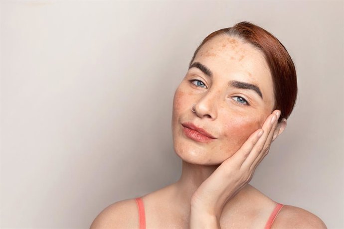 Archivo - Melasma, pecas, mujer, piel.