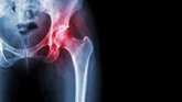 Foto: ¿Tienes artrosis de cadera? El ejercicio que más recomiendan los traumatólogos (y el que conviene evitar)