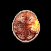 Foto: Empresas.- Siemens Healthineers recibe 26,5 millones de euros de ARPA-H para impulsar la robótica endovascular autónoma