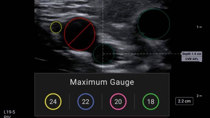 FUJIFILM Sonosite presenta PIV Assist, una función basada en IA para acceso intravenoso periférico