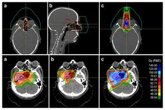 Foto: La reirradiación con protonterapia logra una supervivencia del 67% en pacientes con recaída de cáncer de cabeza y cuello