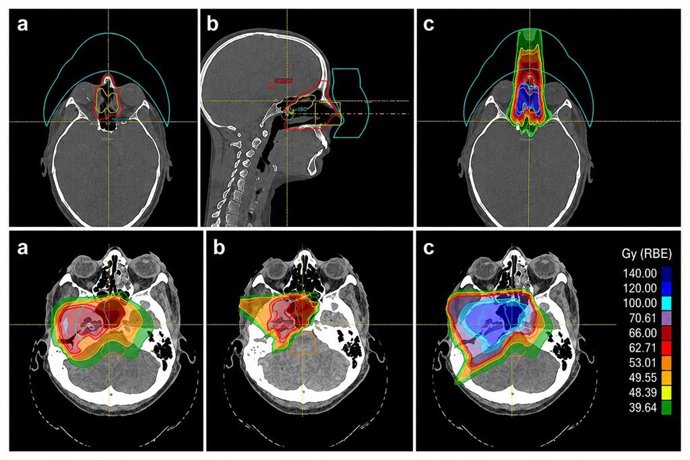 Imagen de cómo la protonterapia concentra la radiación en el tumor durante una reirradiación, preservando al máximo los tejidos sanos ya tratados.