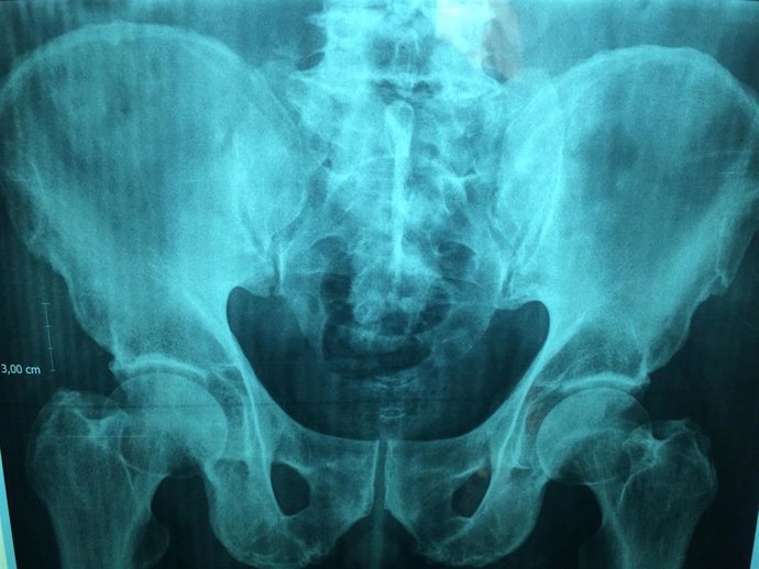 Investigadores evalúan la precisión de una nueva herramienta para ayudar a identificar a las personas con alto riesgo de fractura de cadera utilizando datos sanitarios y demográficos recopilados de forma rutinaria.