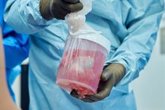 Foto: Un riñón de cerdo modificado genéticamente mantiene 271 días sin diálisis hasta recibir un trasplante humano