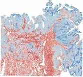 Foto: Un programa del CNAG reconstruye las reacciones metabólicas del cáncer en el mismo tejido