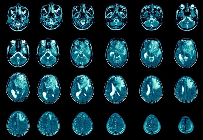 Archivo - Glioblastoma, cerebro metastasis