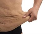 Foto: ¿Qué pasa con la piel después de perder muchos kilos? El reto del exceso de piel tras adelgazar