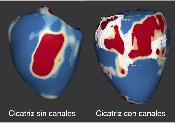 Resonancia magnética de dos pacientes con miocardiopatía dilatada