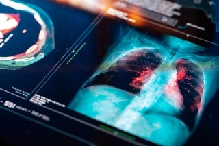 Archivo - Resonancia magnética de los pulmones.