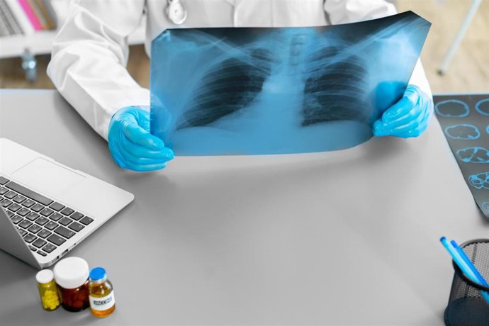 Archivo - Doctor examinando unos pulmones en una radiografía