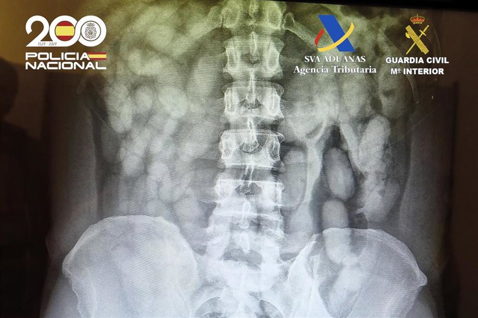 Radiografía detenido con envoltorios de cocaína