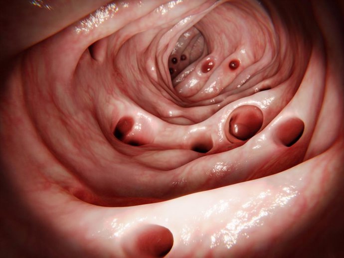 Archivo - Diverticulosis masiva en intestinte humano. Resultados de la diverticulitis de la inflamación de uno de los divertículos
