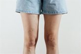 Foto: Un experto advierte de que las piernas hinchadas y las varices tras el verano no deben normalizarse