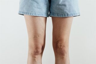 Archivo - Imagen de recurso de una mujer con las piernas hinchadas.