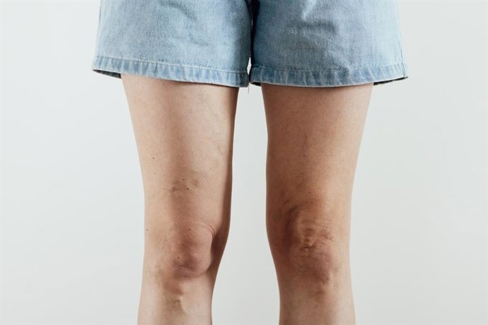 Archivo - Imagen de recurso de una mujer con las piernas hinchadas.