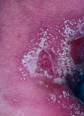 Foto: Experto recuerda que la psoriasis pustulosa generalizada es multisistémica y requiere atención multidisciplinar