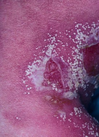 Experto indica que la psoriasis pustulosa generalizada es multisistémica y requiere atención multidisciplinar