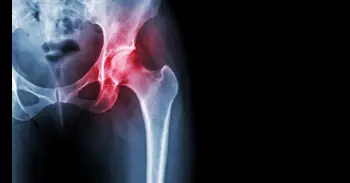 Artrosis de cadera y envejecimiento saludable, claves para cuidar una de las articulaciones más importantes del cuerpo