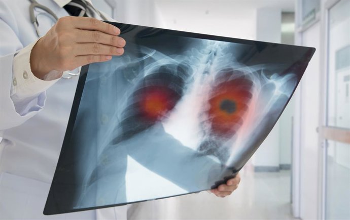 Archivo - Imagen de recurso de un médico examinando unos pulmones.
