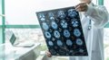 La SEN insiste en su petición de que Sanidad reconsidere su decisión y financie los nuevos fármacos contra el Alzheimer