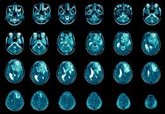 Foto: Glioma: descubren que la biología de este agresivo cáncer cerebral cambia alrededor de los 26 años
