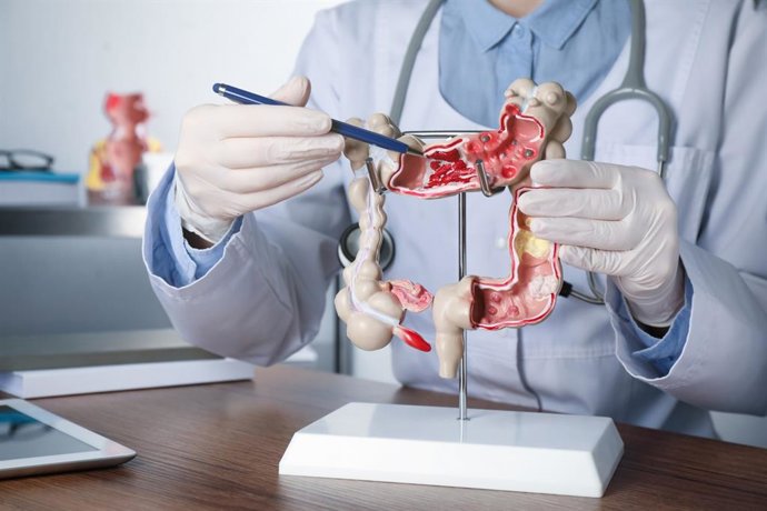 Archivo - Gastroenterólogo muestra el modelo de colon humano.