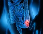 Foto: Cáncer colorrectal: los casos metastásicos siguen aumentando en menores de 45 años y alertan sobre sus síntomas