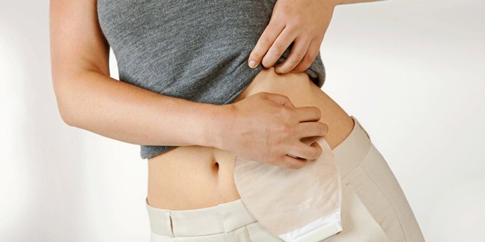 Archivo - Una persona ostomizada cuidando su dispositivo.