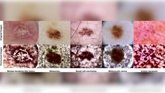 Foto: Diseñan un sistema con IA que clasifica lesiones cutáneas