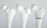 Foto: Internistas destacan su papel en el abordaje integral de osteoporosis por la frecuente polimedicación y comorbilidades